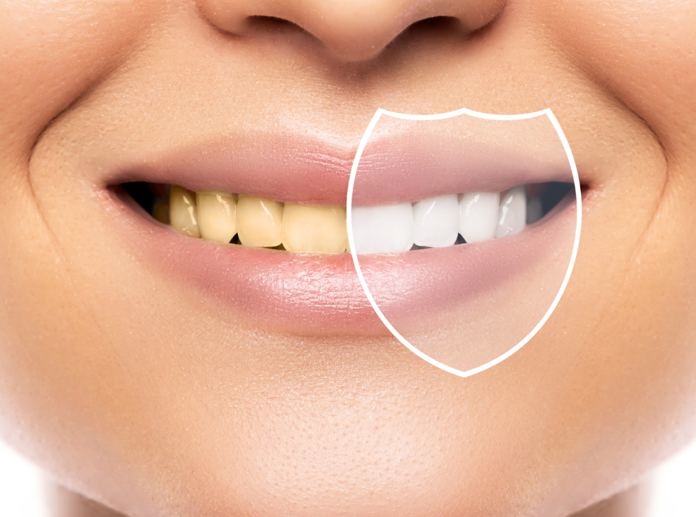 Blanchiment des dents